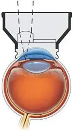 YAG Iridectomy Lens - Opticlear - Image 3